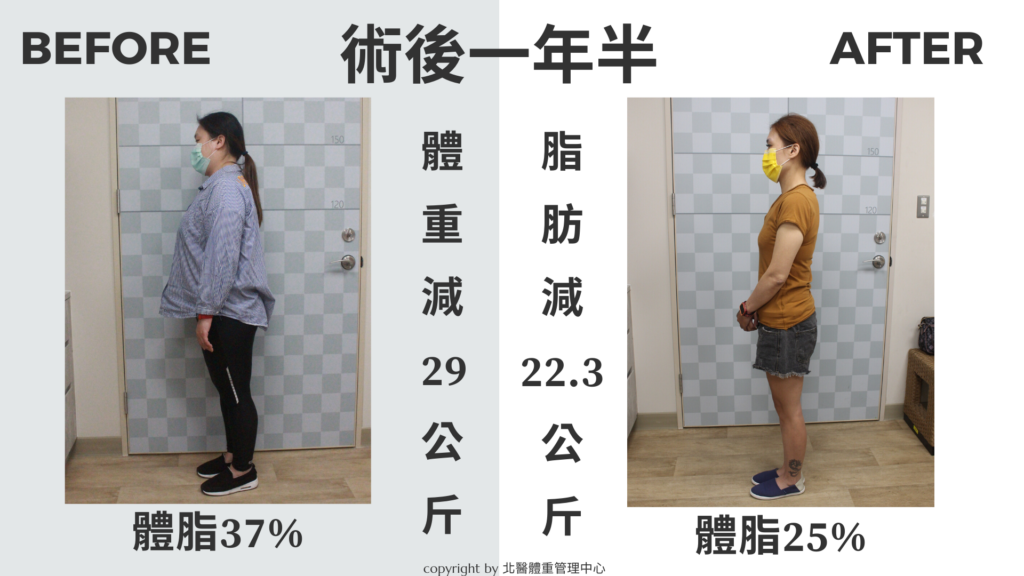 手術成功案例 全方位體重管理中心 臺北醫學大學附設醫院